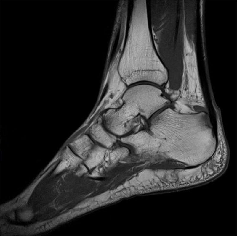 Irm Maladie Charcot / Sclérose latérale amyotrophique (SLA) / maladie — free download
